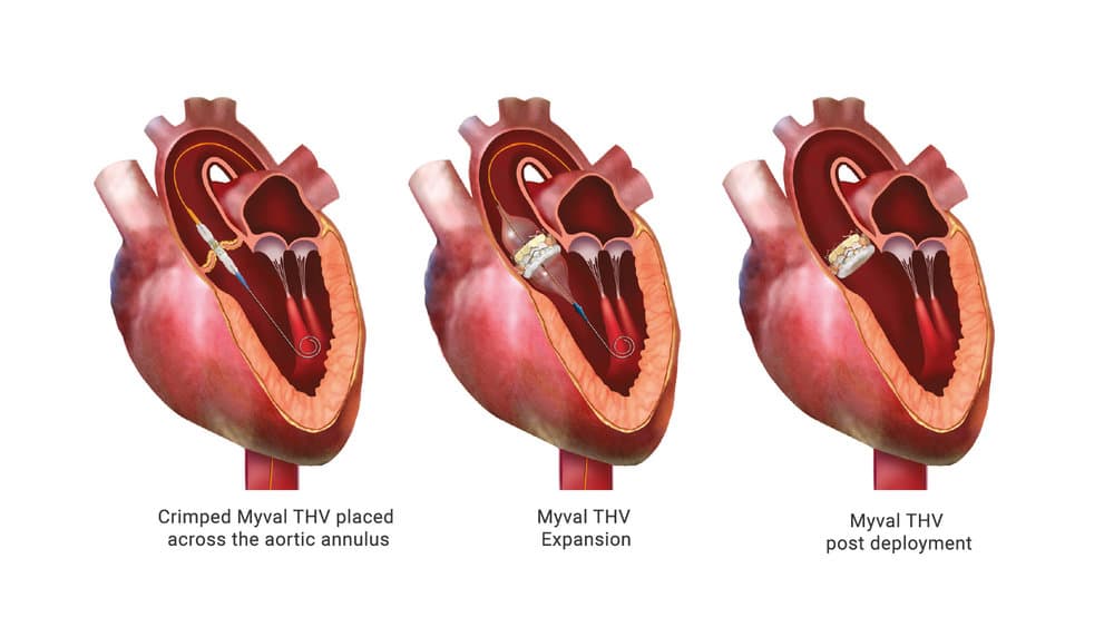 Procedure of TAVR